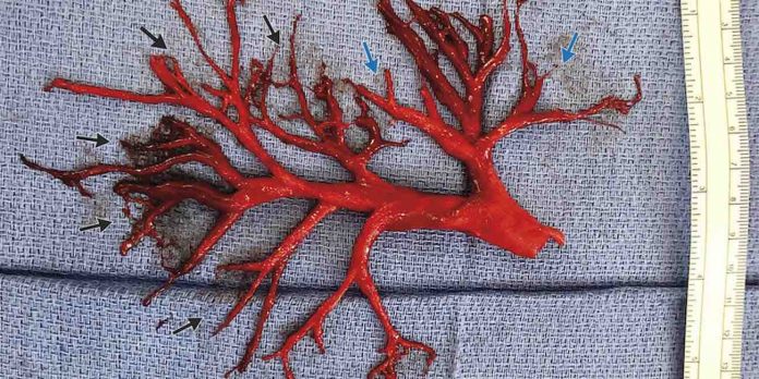 The man coughs up the huge blood clot in the form of a bronchial tree (Video)