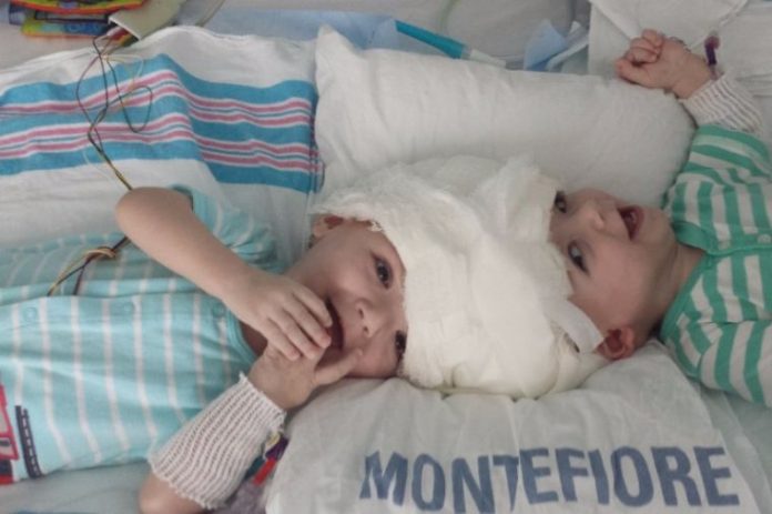 Separated Twins Begin Recovery: Parents meet conjoined twins for the first time after surgery