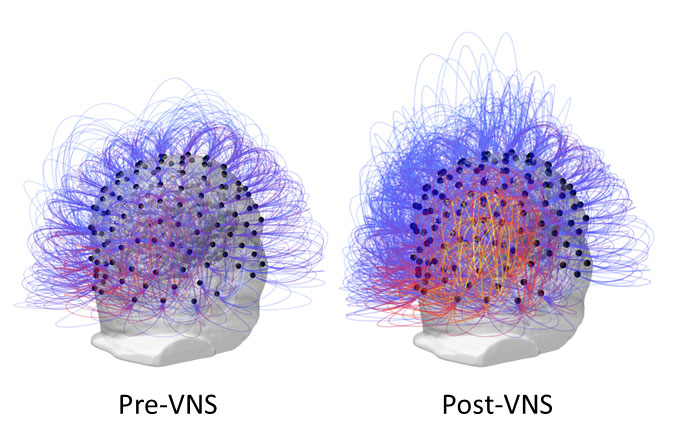 After 15 Years in a Vegetative State, Researchers Partly Restore Consciousness in Patient