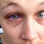 Canadian woman gets eye tattooed and it goes horribly wrong Canadian woman gets eye tattooed and it goes horribly wrong