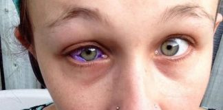 Canadian woman gets eye tattooed and it goes horribly wrong Canadian woman gets eye tattooed and it goes horribly wrong