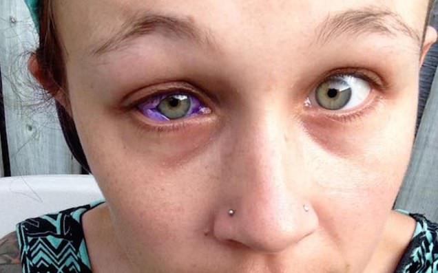 Canadian woman gets eye tattooed and it goes horribly wrong