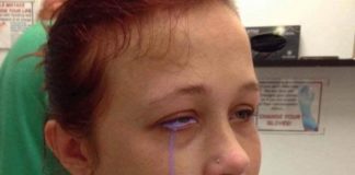 Eyeball Tattoo Leaves Woman In Pain And Partially Blind Eyeball Tattoo Leaves Woman In Pain And Partially Blind