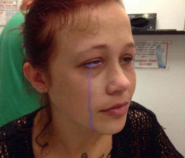 Eyeball Tattoo Leaves Woman In Pain And Partially Blind