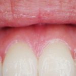 Research ties gum disease bacteria to esophageal cancer Research ties gum disease bacteria to esophageal cancer