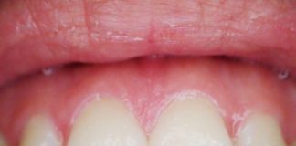 Research ties gum disease bacteria to esophageal cancer Research ties gum disease bacteria to esophageal cancer