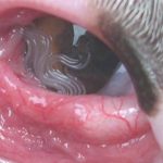 US Woman Finds 14 Worms Living in Her Eye US Woman Finds 14 Worms Living in Her Eye