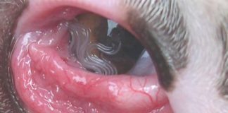 US Woman Finds 14 Worms Living in Her Eye US Woman Finds 14 Worms Living in Her Eye
