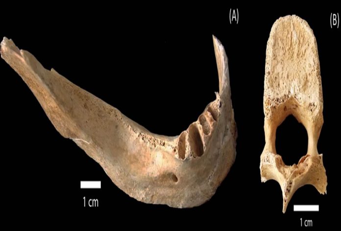 Researchers Studied The Bone Of A Hiroshima Victim. This Is What They Found