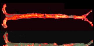 Science: Antibody blocks inflammation, protects mice from hardened arteries and liver disease — (research)