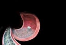 Tech: ‘Surgery in a pill’ a potential treatment for diabetes — (Report)