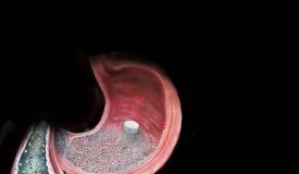 Tech: ‘Surgery in a pill’ a potential treatment for diabetes — (Report)