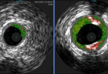 Research: Allergen in red meat linked to heart disease —