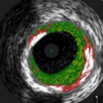 Study: Patients sensitive to allergen had 30 percent more plaque in heart arteries — (Details)