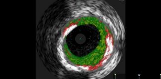 Study: Patients sensitive to allergen had 30 percent more plaque in heart arteries — (Details)