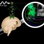 Study: In brains affected by Alzheimer’s, researchers identify chemically reduced iron species, with mineral forms including a magnetic iron oxide — (Details)