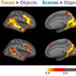 Study: Many people with facial blindness also have abnormalities in brain regions that process scenes and bodies — (Details)