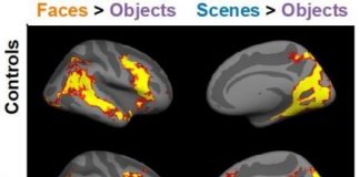 Study: Many people with facial blindness also have abnormalities in brain regions that process scenes and bodies — (Details)