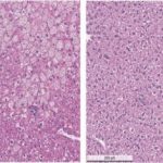 Study: Progress toward improved Wilson’s disease drug — (Details)