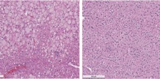 Study: Progress toward improved Wilson’s disease drug — (Details)