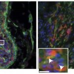 Study: Breast cancer growth signals are enhanced by a protein outside cells — (Details)