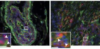 Study: Breast cancer growth signals are enhanced by a protein outside cells — (Details)