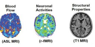 Study: Technique can be used to better categorize patients with neurological disease, according to their therapeutic needs — (Details)