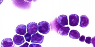 Study: Preclinical study points to potential treatment targets for aggressive pediatric leukemia — (Details)