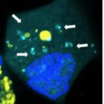 Study: Scientists create nano-size packets of genetic code aimed at brain cancer ‘seed’ cells — (Details)