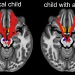 Study: Key social reward circuit in the brain impaired in kids with autism — (Details)