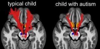 Study: Key social reward circuit in the brain impaired in kids with autism — (Details)