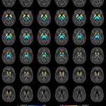 Study: Brain iron levels may predict multiple sclerosis disabilities — (Details)