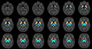 Study: Brain iron levels may predict multiple sclerosis disabilities — (Details)