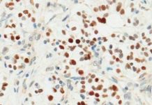 Research: Discovery of kidney cancer driver could lead to new treatment strategy —