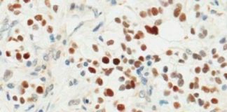 Research: Discovery of kidney cancer driver could lead to new treatment strategy —