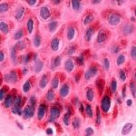 Study: Molecular mechanisms of rare skin disease uncovered — (Details)