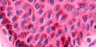 Study: Molecular mechanisms of rare skin disease uncovered — (Details)