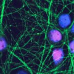 Study: Alzheimer’s drug may stop disease if used before symptoms develop, study suggests — (Details)