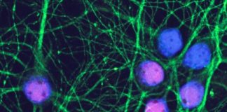 Study: Alzheimer’s drug may stop disease if used before symptoms develop, study suggests — (Details)