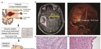 Study: Origin cells for deadly brain tumors identified — (Details)