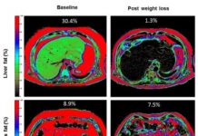 Research: Why weight loss produces remission of type 2 diabetes in some patients —