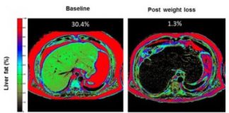 Research: Why weight loss produces remission of type 2 diabetes in some patients —