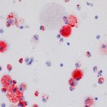 Study: Researchers learn what causes pulmonary alveolar proteinosis (PAP) to clog lungs — (Details)