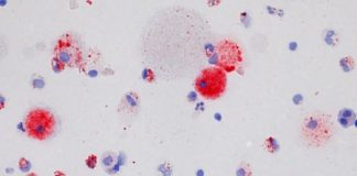 Study: Researchers learn what causes pulmonary alveolar proteinosis (PAP) to clog lungs — (Details)