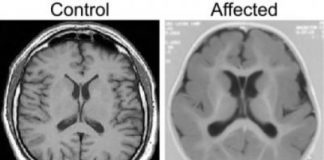 Study: Pachygyria characterized by irregular unfolding of brain surface cells — (Details)