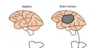 Study: Brain cancer potentially resists immunotherapies by trapping T cells in bone marrow — (Details)