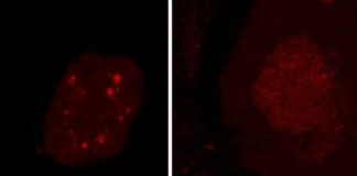 Study: Discovery may lead to new ways of diagnosing and treating both diseases — (Details)