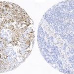 Study: Researchers have identified 6 protein kinases whose functional status predicts the evolution of triple negative breast cancer — (Details)