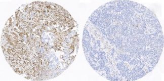 Study: Researchers have identified 6 protein kinases whose functional status predicts the evolution of triple negative breast cancer — (Details)