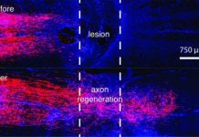 Research: A recipe for regenerating nerve fibers across complete spinal cord injury —